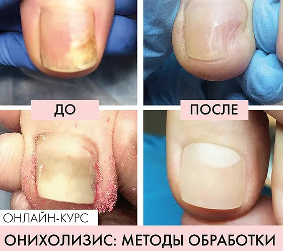 Карина Шурыгина - Онихолизис